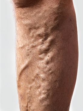 varicose veins