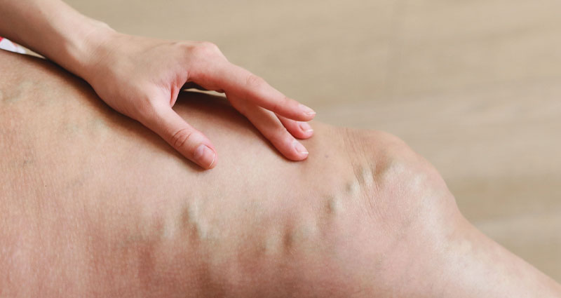 leg with bulging vein