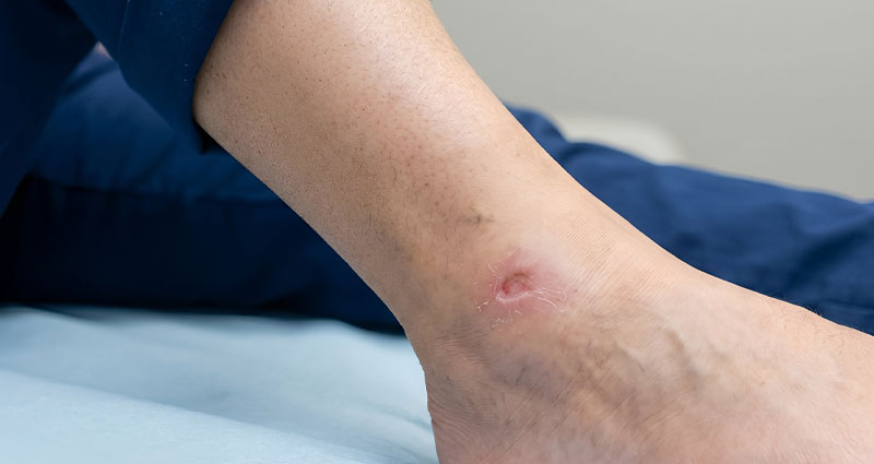 leg with sore