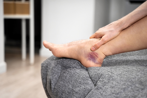 man holding ankle with dark bruise